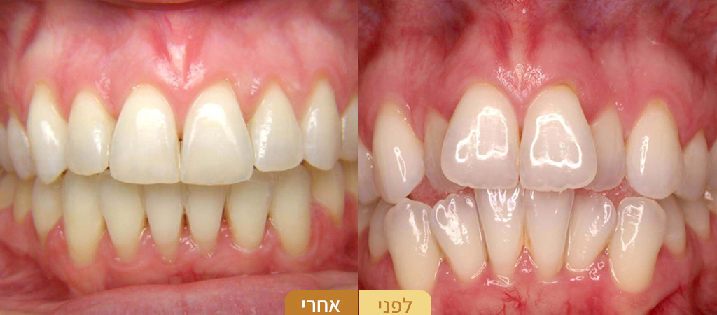לפני-אחרי-יישור-שיניים-לבוגרים-2.jpg